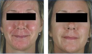Rosacea Laser Treatment Before and After
