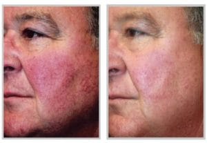 Rosacea Laser Treatment Before and After