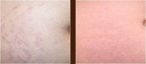 Stretch Mark Laser Treatment Before and After