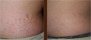 Stretch Mark Laser Treatment Before and After
