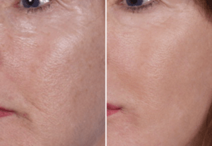 NanoLaserPeel After 5 Months